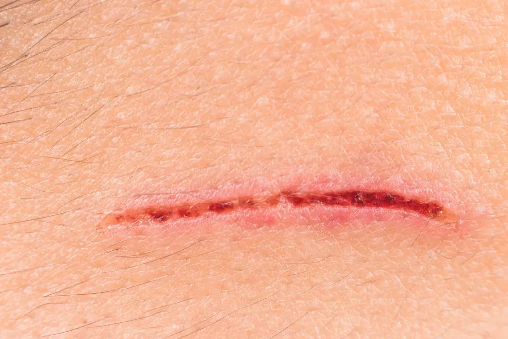 How to Know if That Cut Needs Stitches